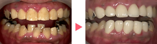 治療前→治療後の前歯の写真