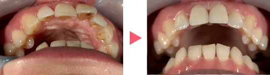 治療前→治療後の奥歯の写真